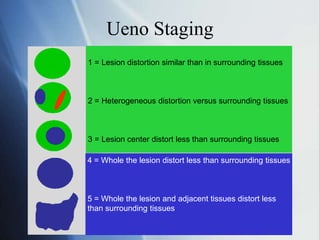 Ueno Staging
1 = Lesion distortion similar than in surrounding tissues
2 = Heterogeneous distortion versus surrounding tissues
3 = Lesion center distort less than surrounding tissues
4 = Whole the lesion distort less than surrounding tissues
5 = Whole the lesion and adjacent tissues distort less
than surrounding tissues
 
