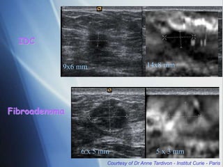 9x6 mm 14x8 mm
IDC
6 x 5 mm 5 x 3 mm
Fibroadenoma
Courtesy of Dr Anne Tardivon - Institut Curie - Paris
 