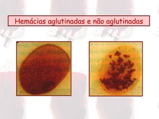 Hemácias aglutinadas e não aglutinadas 