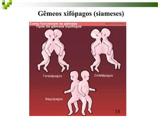 18
Gêmeos xifópagos (siameses)
 