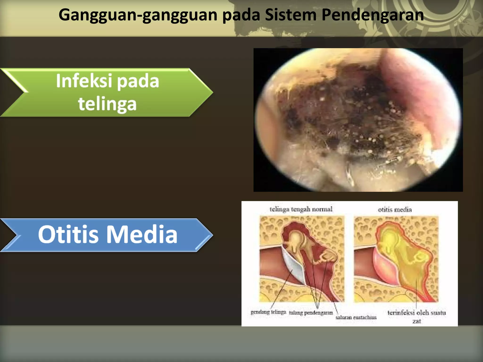 Gangguan-gangguan pada Sistem Pendengaran

 
