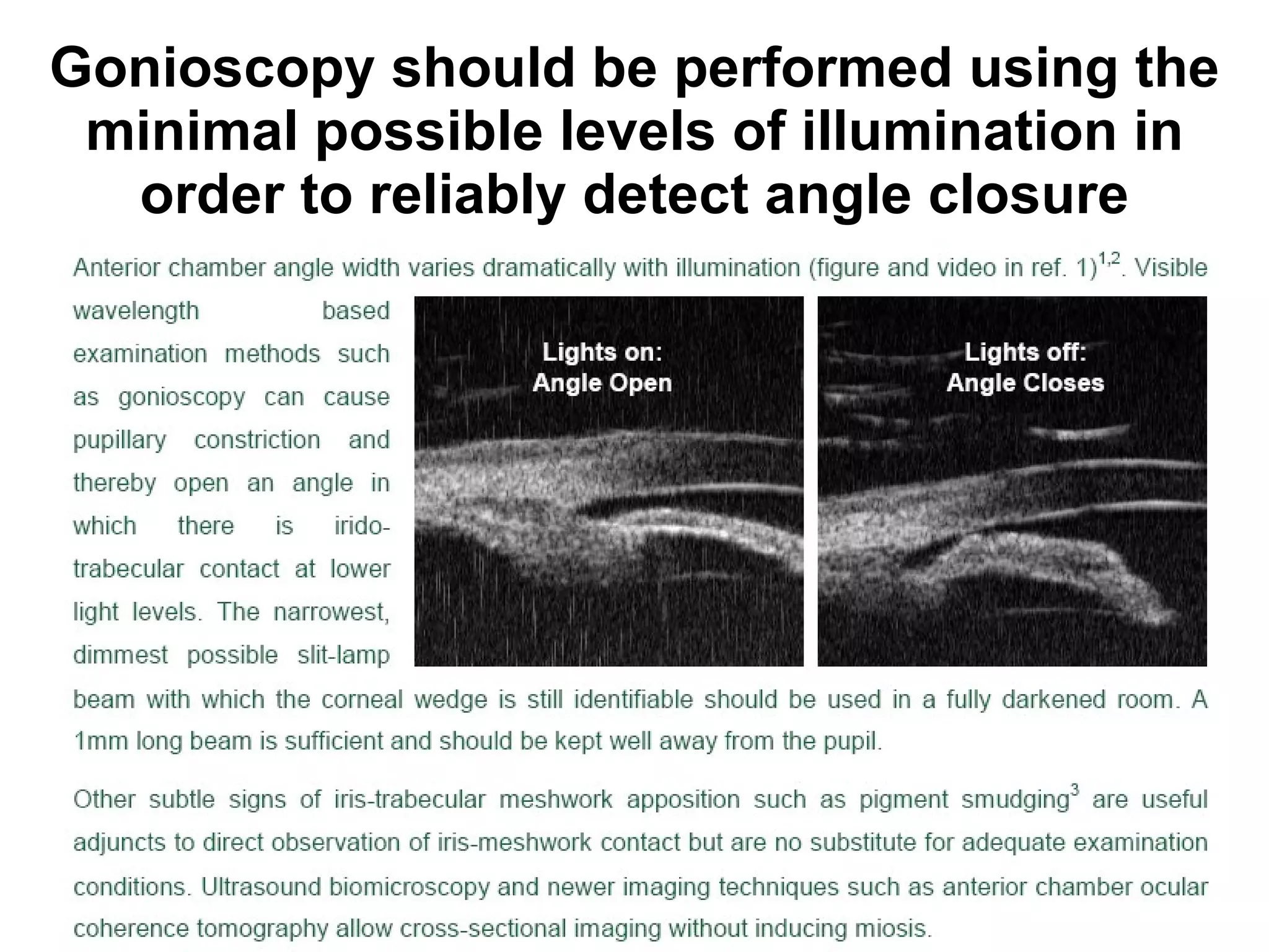 Gonioscopy should be performed using the minimal possible levels of illumination in order to reliably detect angle closure 
