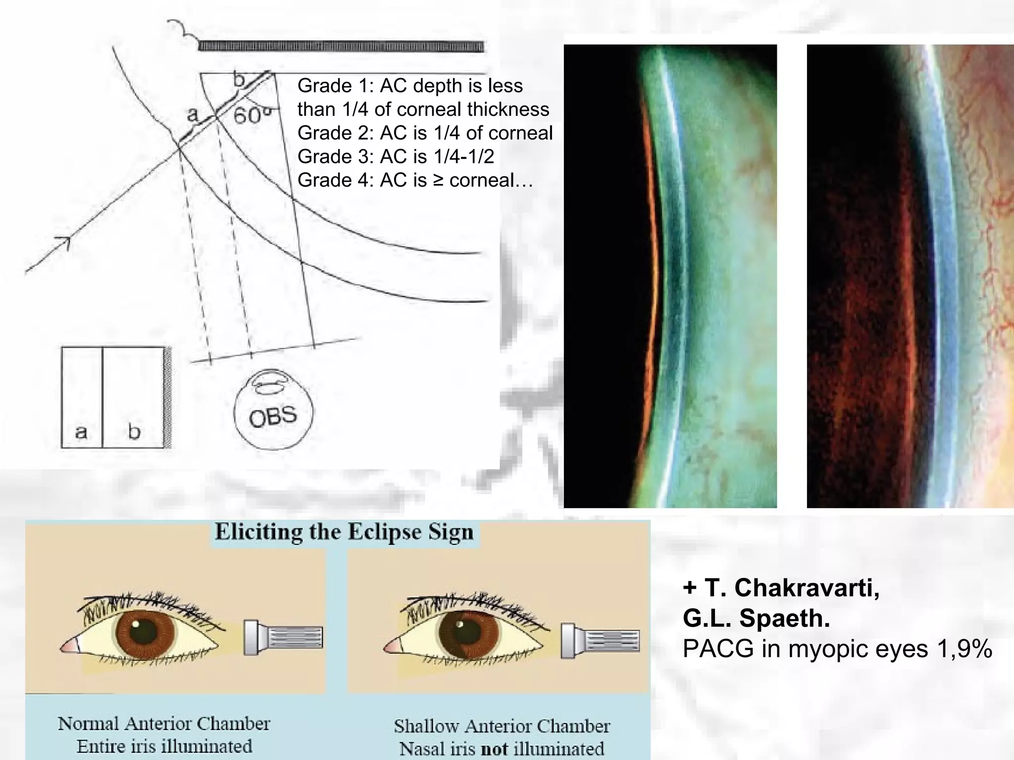 +  T. Chakravarti,  G.L. Spaeth.   PACG in myopic eyes 1,9% Grade 1: AC depth is less than 1/4 of corneal thickness  Grade 2: AC is 1/4 of corneal Grade 3: AC is 1/4-1/2  Grade 4: AC is ≥   corneal… 