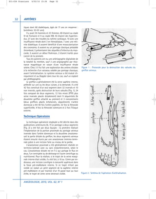 031-036 Francisco    4/02/10 15:36        Page 32




     32     ARTÈRES

            tiques dont 60 diabétiques, âgés de 71 ans en moyenne :
            (extrêmes: 53-91 ans).
               Il y avait 55 hommes et 23 femmes. 69 étaient au stade
            IV de Fontaine et 9 au stade IIIB. 55 étaient des hyperten-
            dus, 27 avec des troubles du rythme cardiaque, 10 avec une
            insuffisance rénale dont 3 en hémodialyse, 7 avec une réti-
            nite diabétique. 6 avaient bénéficié d’une revascularisation
            des coronaires. 6 avaient eu un pontage classique préalable
            thrombosé, 5 présentaient des séquelles d’infarctus du myo-
            carde, 5 avaient un début Parkinson, 2 étaient traités pour
            cancer de la prostate.
               Tous les patients ont eu une artériographie digitalisée de
            la totalité du membre, sauf 3 une angiographie par réso-
            nance magnétique en raison d’une insuffisance rénale
            sévère. Chez 3 il fut fait une exploration des artères distales   Figure 1 : Protocole pour la destruction des valvules du
            à la recherche d’un vaisseau valable par pontage classique,       greffon veineux.
            avant l’artérialisation. Le système veineux a été évalué cli-
            niquement et au Doppler dans tous les cas, sauf un exploré
            par phlébographie.
               Le greffon a généralement été la veine saphène interne,
            prélevée sur une ou les deux cuisses, à la demande. Il a été
            42 fois constitué d’un seul segment dont 32 inversés et 10
            non inversés, après destruction de leurs valvules (Fig. 1), 24
            fois composé de deux segments, 12 fois mixte (PTFE plus
            veine inversée placée distalement) dont 9 séquentiels (le
            deuxième greffon attaché au premier) et 3 concomitants
            (deux greffons placés échelonnés, séparément). L’artère
            donneuse a été 40 fois l’artère poplitée, 32 fois la fémorale
            superficielle, 4 fois la fémorale commune et 2 fois l’ilíaque
            externe.

            Technique Opératoire

                La technique opératoire employée a été décrite dans des
            publications antérieures (6, 7) Le pontage à deux segments
            (Fig. 2) a été fait par deux équipes : la première réalisait
            l’implantation de la portion proximale du pontage veineux
            inversée dans l’artère donneuse et la deuxième anastomo-
            sait la partie distale du greffon; les deux segments veineux
            étaient ensuite réunis par une anastomose tremino-termi-
            nale grâce à une incision faite au niveau de la jambe.
                L’anastomose proximale a été généralement réalisée en
            terrmino-latérale avec ou sans endartérectomie, selon le
            cas. L’anastomose distale est en T-L qui partage le flux en
            deux, l’un centripète ou de décharge et l’autre centrifuge ou
            nutritionnel. Pour la réaliser, si le trajet de la veine margi-
            nale interne était visible, il a été fait, à 10 ou 12mm par en-
            dessous, une incision curviligne à concavité supérieure dans
            la fosse pré-malléolaire interne. Si ce trajet n’était pas
            visible on isolait un petit segment de la saphène interne
            pré-malléolaire et par traction d’un fil passé tout au tour
            d’elle, le trajet de cette veine devenait visible.                Figure 2 : Schéma de l’opération d’artérialisation.


            ANGÉIOLOGIE, 2010, VOL. 62, N° 1
 