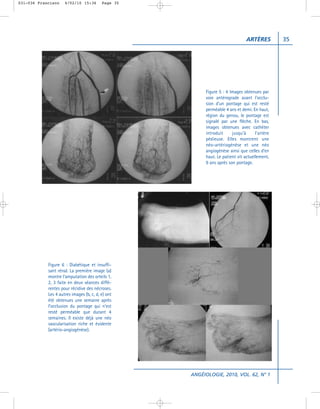 031-036 Francisco    4/02/10 15:36        Page 35




                                                                                ARTÈRES         35




                                                          Figure 5 : 4 Images obtenues par
                                                          voie antérograde avant l’occlu-
                                                          sion d’un pontage qui est resté
                                                          perméable 4 ans et demi. En haut,
                                                          région du genou, le pontage est
                                                          signalé par une flèche. En bas,
                                                          images obtenues avec cathéter
                                                          introduit     jusqu’à      l’artère
                                                          pédieuse. Elles montrent une
                                                          néo-artériogénèse et une néo
                                                          angiogénèse ainsi que celles d’en
                                                          haut. Le patient vit actuellement,
                                                          9 ans après son pontage.




            Figure 6 : Diabétique et insuffi-
            sant rénal. La première image (a)
            montre l’amputation des orteils 1,
            2, 3 faite en deux séances diffé-
            rentes pour récidive des nécroses.
            Les 4 autres images (b, c, d, e) ont
            été obtenues une semaine après
            l’occlusion du pontage qui n’est
            resté perméable que durant 4
            semaines. Il existe déjà une néo
            vascularisation riche et évidente
            (artério-angiogénèse).




                                                    ANGÉIOLOGIE, 2010, VOL. 62, N° 1
 