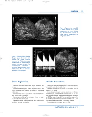 037-040 Verlhac    4/02/10 15:36      Page 39




                                                                                                                          ARTÈRES           39




                                                                                                    Figure 1. A gauche vue axiale 2D.
                                                                                                    Le repère essentiel est la bonne
                                                                                                    visualisation du tronc cérébral
                                                                                                    (TC). A droite après passage en
                                                                                                    mode couleur, visualisation du
                                                                                                    polygone de Willis.




         Figure 2. Enregistrement en mode
         Doppler pulsé du spectre des
         vitesses de l’artère cérébrale
         moyenne. La TAMV obtenue par
         tracé manuel de l’enveloppe des
         vitesses maximales au cours d’un
         cycle est égale à 150 cm/sec. La
         largeur de la porte Doppler pulsée
         est de 5 mm. Aucune correction
         angulaire n’est appliquée.




         Critères diagnostiques                                         Intervalles de surveillance

            L’examen est classé dans l’une des 4 catégories sui-            Débuter la surveillance par EDTC des enfants drépanocy-
         vantes.                                                        taires dès la seconde année de vie.
            Examen normal lorsque la vitesse moyenne TAMV la plus           Répéter l’examen une fois par an s’il est normal, tous les
         élevée enregistrée dans chacune des artères est inférieure à   3 mois s’il est limite.
         170 cm/sec.                                                        En cas d’examen Doppler anormal, débuter les transfusions
            Examen limite lorsque qu’au moins une vitesse est com-      immédiatement. Contrôler l’EDTC après 3 mois. S’il est tou-
         prise entre 170 et 199 cm/sec.                                 jours anormal ou limite, poursuivre les transfusions et contrô-
            Examen anormal lorsqu’au moins une vitesse est supé-        ler l’EDTC au bout d’un an. S’il s’est normalisé, on peut arrêter
         rieure ou égale à 200 cm/sec.                                  les transfusions à condition de contrôler l’EDTC tous les 3 mois
            Examen incomplet quand l’une ou les deux fenêtres tem-      et de reprendre les transfusions s’il redevient anormal.
         porales ne sont pas perméables.                                    En cas d’examen incomplet faire une IRM.


                                                                                          ANGÉIOLOGIE, 2010, VOL. 62, N° 1
 