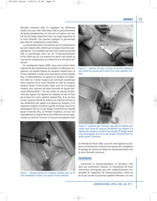 047-055 Creton   4/02/10 15:38        Page 53




                                                                                                                             VEINES         53

         fémorale commune (45). En regardant ces différentes
         études ainsi que celle d’Earnshaw (36) et particulièrement
         les photos peropératoires, on voit que ces auteurs ont réa-
         lisé de très larges dissections avec une large exposition de
         la veine fémorale. Ceci pourrait expliquer le pourcentage
         plus élevé de complications cicatricielles.
             La néovascularisation est produite par les complications
         qui sont induites elles-mêmes par de larges dissections per-
         opératoires. Il est probable que dans mon étude personnelle
         (44) le pourcentage assez bas de re-néovascularisation
         (4 %) n’était pas dû à la présence du patch mais plutôt au
         taux bas de complications, lui-même dû à la très petite dis-
         section.
             En conséquence depuis 2000, nous avons encore réduit
         l’agressivité des interventions de récidive en effectuant uni-    Figure 2 : Injection de bas en haut de liquide sclérosant
         quement une double ligature du moignon résiduel avec un           sous forme de mousse par le biais d’un tronc saphène rési-
         fil non résorbable à travers une toute petite incision latérale   duel.
         (Fig. 1). Habituellement, la ligature du moignon est adven-
         tice aisée car il existe toujours une continuité anatomique
         entre l’adventis de la veine fémorale et celle du moignon
         résiduel. Durant l’intervention, après avoir lié le moignon
         résiduel, nous injectons de façon sécurisée du liquide sclé-
         rosant (Aetoxisclérol 1 %) sous forme de mousse, distale-
         ment par rapport à la ligature du moignon, de bas en haut
         par le biais d’un tronc saphène résiduel (Fig. 2) ou de haut
         en bas. Lorsqu’on décide de réaliser une injection de haut en
         bas, distalement par rapport à la ligature du moignon, il est
         important d’utiliser une petite aiguille 25 Gauge munie d’un
         prolongateur afin de ne pas bouger l’extrémité de l’aiguille
         durant l’injection (Fig. 3). Pendant l’injection, on peut voir
         habituellement le blanchiment des différentes veines appa-
         raissant au fond de l’incision. La mousse est préparée selon


                                                                           Figure 3 : Injection par l’incision inguinale de liquide sclé-
                                                                           rosant sous forme de mousse, distalement par rapport à la
                                                                           ligature du moignon, à l’aide d’une aiguille 25 Gauge munie
                                                                           d’un prolongateur afin de ne pas bouger l’extrémité de l’ai-
                                                                           guille durant l’injection.

                                                                           la méthode de Tessari (46). Le but de cette ligature du moi-
                                                                           gnon est de sécuriser l’injection de mousse afin d’empêcher
                                                                           le passage de mousse du réseau de néovascularisation vers
                                                                           la veine fémorale commune.

                                                                           Conclusion

                                                                              Concernant la néovascularisation, le chirurgien n’est
                                                                           donc pas entièrement innocent. Le traumatisme de toute
                                                                           intervention chirurgicale peut être malheureusement res-
         Figure 1 : Double ligature du moignon résiduel avec un fil        ponsable de l’apparition de néovascularisation. L’idéal est
         non résorbable à travers une petite incision latérale.            de ne pas toucher à la jonction saphéno fémorale si on veut


                                                                                           ANGÉIOLOGIE, 2010, VOL. 62, N° 1
 