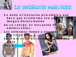 La anorexia nerviosa   Se debe al trastorno psicológico que hace que el enfermo vea una imagen distorsionada  de su cuerpo. Es frecuente en adolescentes.  Los enfermos temen a engordar y hacen un  Ejercicio físico excesivo y siguen una dieta  muy estricta. 