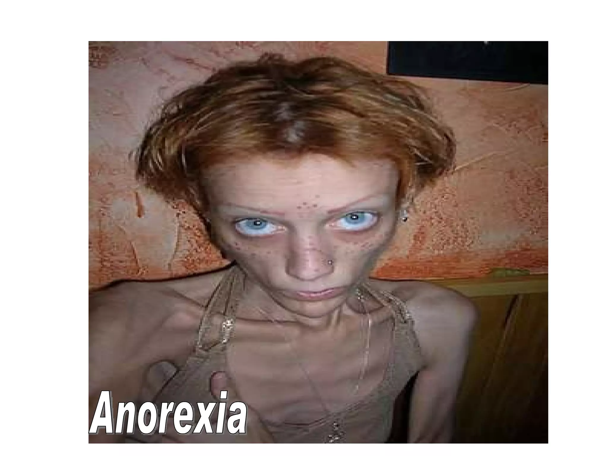 Anorexia