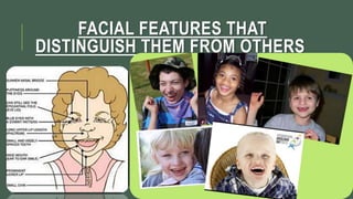 Angelman syndrome assignment | PPTX