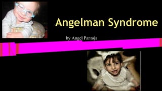 Angelman Syndrome 
by Angel Pantoja 
 