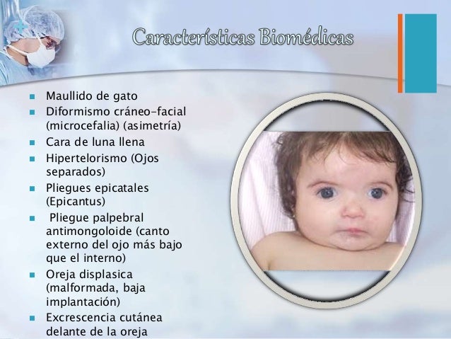 Sindrome De Angelman Y Maulligo De Gato