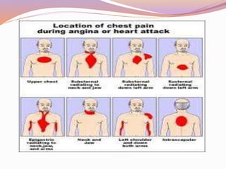 Angina | PPTX