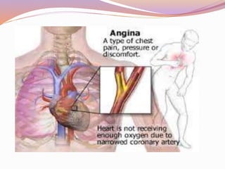 Angina | PPTX