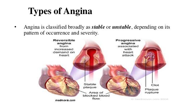 chest pain definition