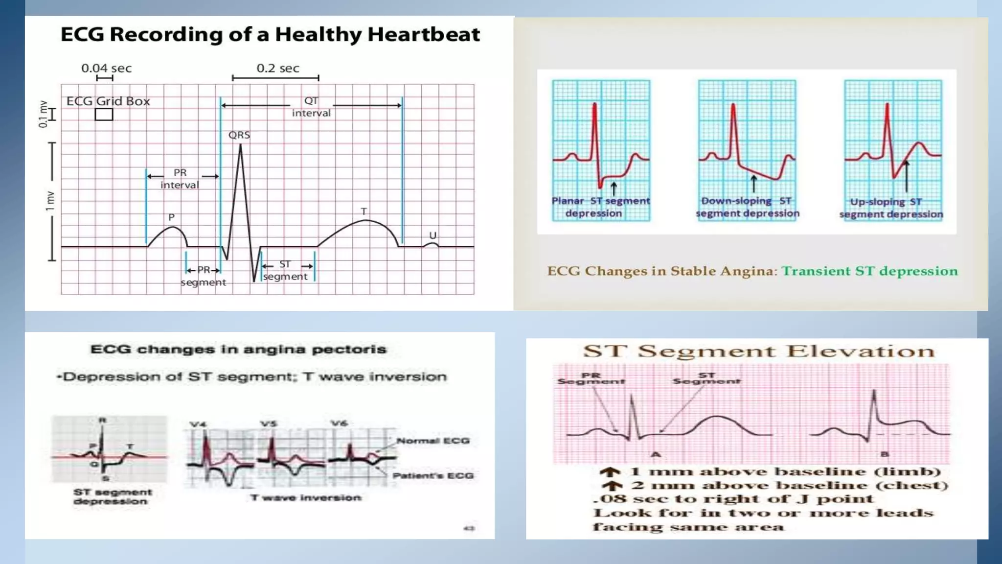Angina | PPTX