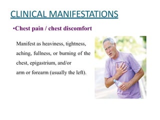 CLINICAL MANIFESTATIONS
•Chest pain / chest discomfort
Manifest as heaviness, tightness,
aching, fullness, or burning of the
chest, epigastrium, and/or
arm or forearm (usually the left).
 