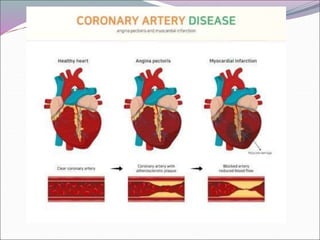 angina.ppt