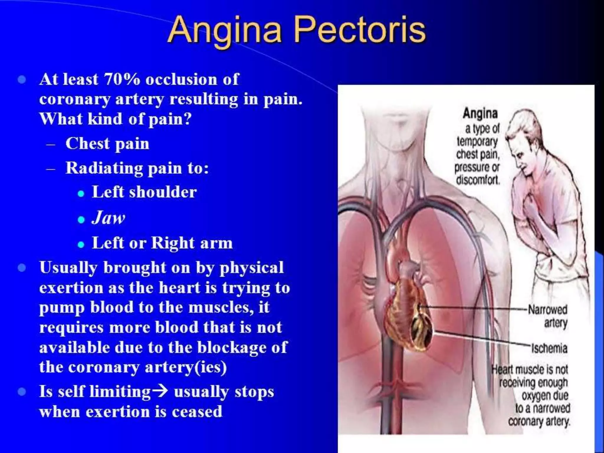 Angina.ppt