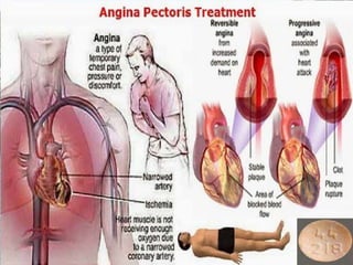 Angina.ppt