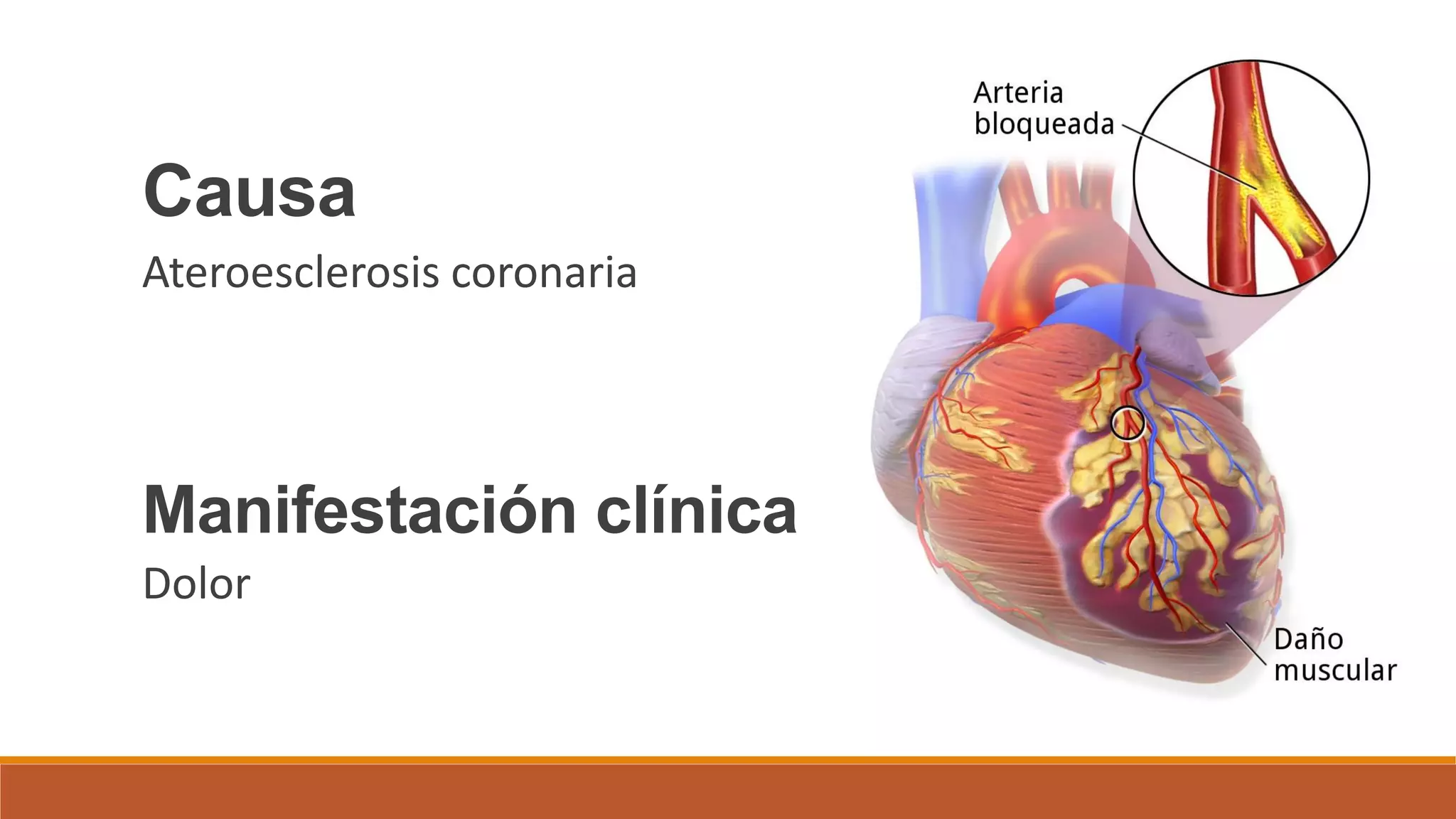 Cardiopatía isquémica: Angina estable e inestable | PDF