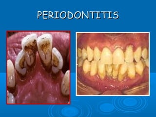 PPEERRIIOODDOONNTTIITTIISS 
 