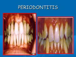 PPEERRIIOODDOONNTTIITTIISS 
 