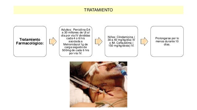 Angina de ludwig Angina de ludwig