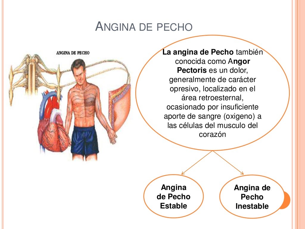 Angina de pecho