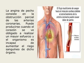 La angina de pecho 
consiste en la 
obstrucción parcial 
de las arterias 
coronarias. Puede 
producirse cuando el 
corazón se ve 
obligado a realizar 
un mayor esfuerzo y 
el organismo es 
incapaz de 
aumentar el riego 
sanguíneo de dicho 
órgano. 
 