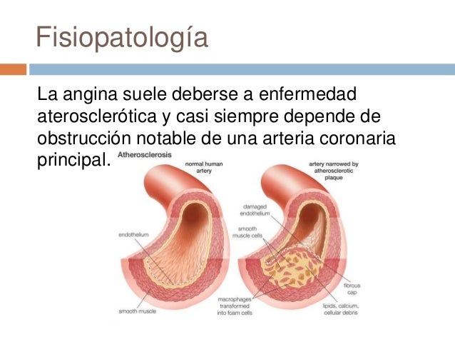 Angina de pecho