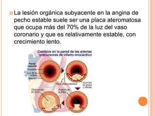  La

lesión orgánica subyacente en la angina de
pecho estable suele ser una placa ateromatosa
que ocupa más del 70% de la luz del vaso
coronario y que es relativamente estable, con
crecimiento lento.

 