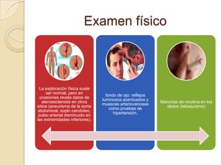Examen físico



 La exploración física suele
     ser normal, pero en
                                  fondo de ojo: reflejos
  ocasiones revela datos de
                                luminosos acentuados y
   ateroesclerosis en otros                                Manchas de nicotina en los
                                muescas arteriovenosas
sitios (aneurisma de la aorta                                dedos (tabaquismo)
                                    como pruebas de
 abdominal, soplo carotídeo,
                                      hipertensión.
 pulso arterial disminuido en
las extremidades inferiores).
 