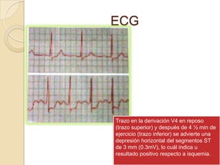 ECG




Trazo en la derivación V4 en reposo
(trazo superior) y después de 4 ½ min de
ejercicio (trazo inferior) se advierte una
depresión horizontal del segmentos ST
de 3 mm (0.3mV), lo cuál indica u
resultado positivo respecto a isquemia.
 