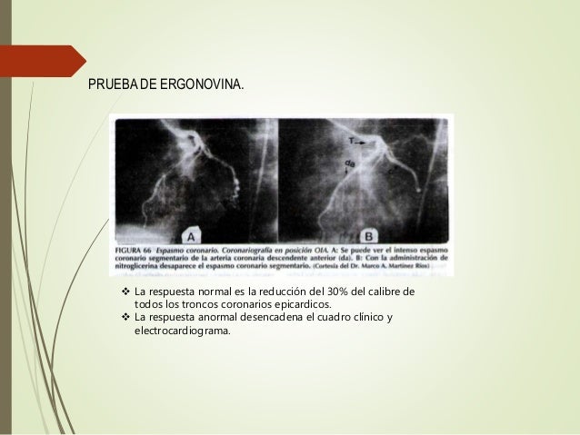 Angina de prinzmetal