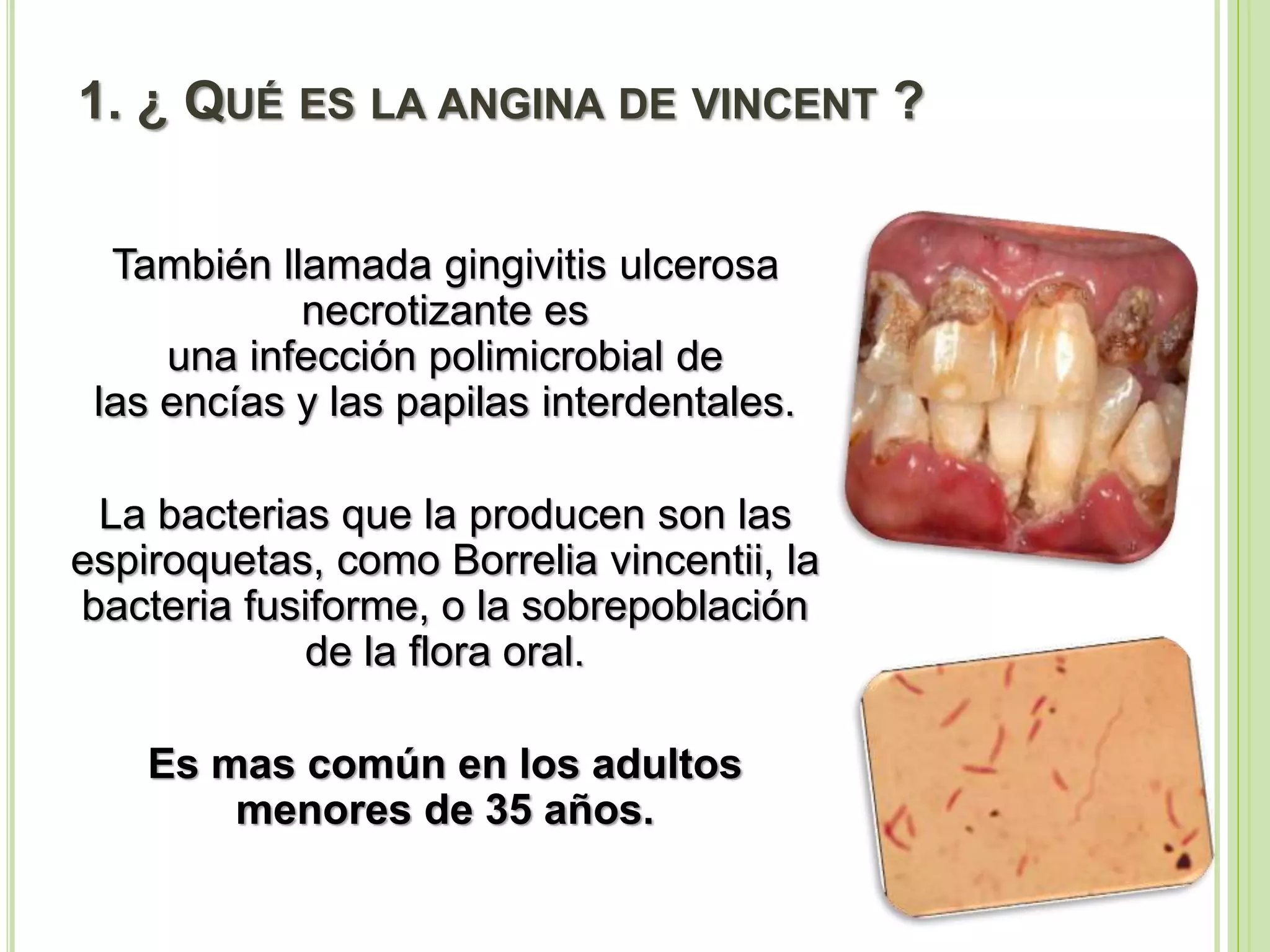 Angina de vincent - modelos unicausal y multicausal | PPT