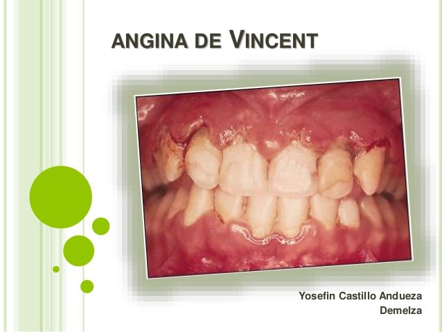 Angina De Vincent Modelos Unicausal Y Multicausal