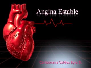 Angina Estable  Cantabrana Valdez Eyra D. 
