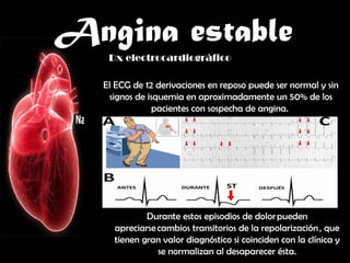 ANGINA ESTABLE manejo clinico y medico de anguna estable.pptx