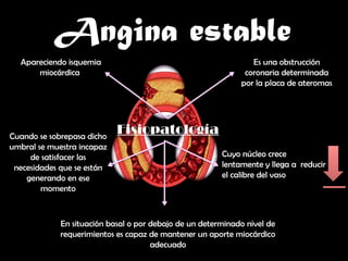 ANGINA ESTABLE manejo clinico y medico de anguna estable.pptx