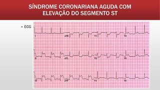 SÍNDROME CORONARIANA AGUDA COM
ELEVAÇÃO DO SEGMENTO ST
 ECG
 