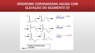 SÍNDROME CORONARIANA AGUDA COM
ELEVAÇÃO DO SEGMENTO ST
 