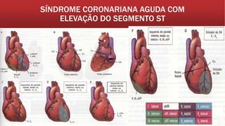 SÍNDROME CORONARIANA AGUDA COM
ELEVAÇÃO DO SEGMENTO ST
 
