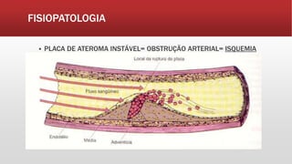 FISIOPATOLOGIA
 PLACA DE ATEROMA INSTÁVEL= OBSTRUÇÃO ARTERIAL= ISQUEMIA
 