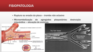 FISIOPATOLOGIA
 Ruptura ou erosão da placa – trombo não oclusivo
 Microembolização de agregados plaquetários- destruição
miocárdica – elevação de enzimas
 