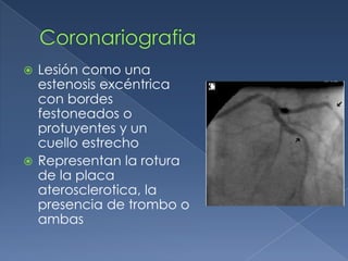 CoronariografiaLesión como una estenosis excéntrica con bordes festoneados o protuyentes y un cuello estrecho Representan la rotura de la placa aterosclerotica, la presencia de trombo o ambas