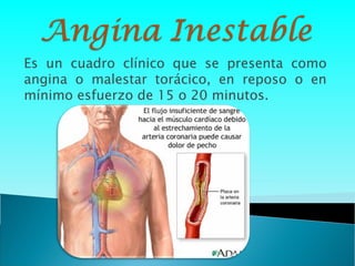 Es un cuadro clínico que se presenta como
angina o malestar torácico, en reposo o en
mínimo esfuerzo de 15 o 20 minutos.
 