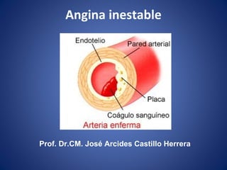 Angina inestable
Prof. Dr.CM. José Arcides Castillo Herrera
 