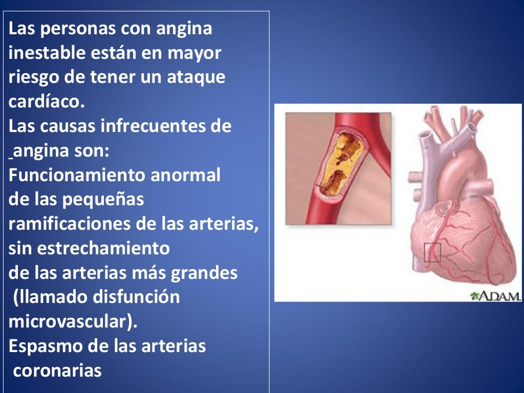 Angina inestable