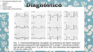 • Pseudonormalización de
onda T.
• BRIHH
• Sobrecarga
• Hipertrofia ventricular Izq.
 